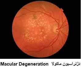 age related macular degeneration تخریب سنی لکه زرد شبکیه
